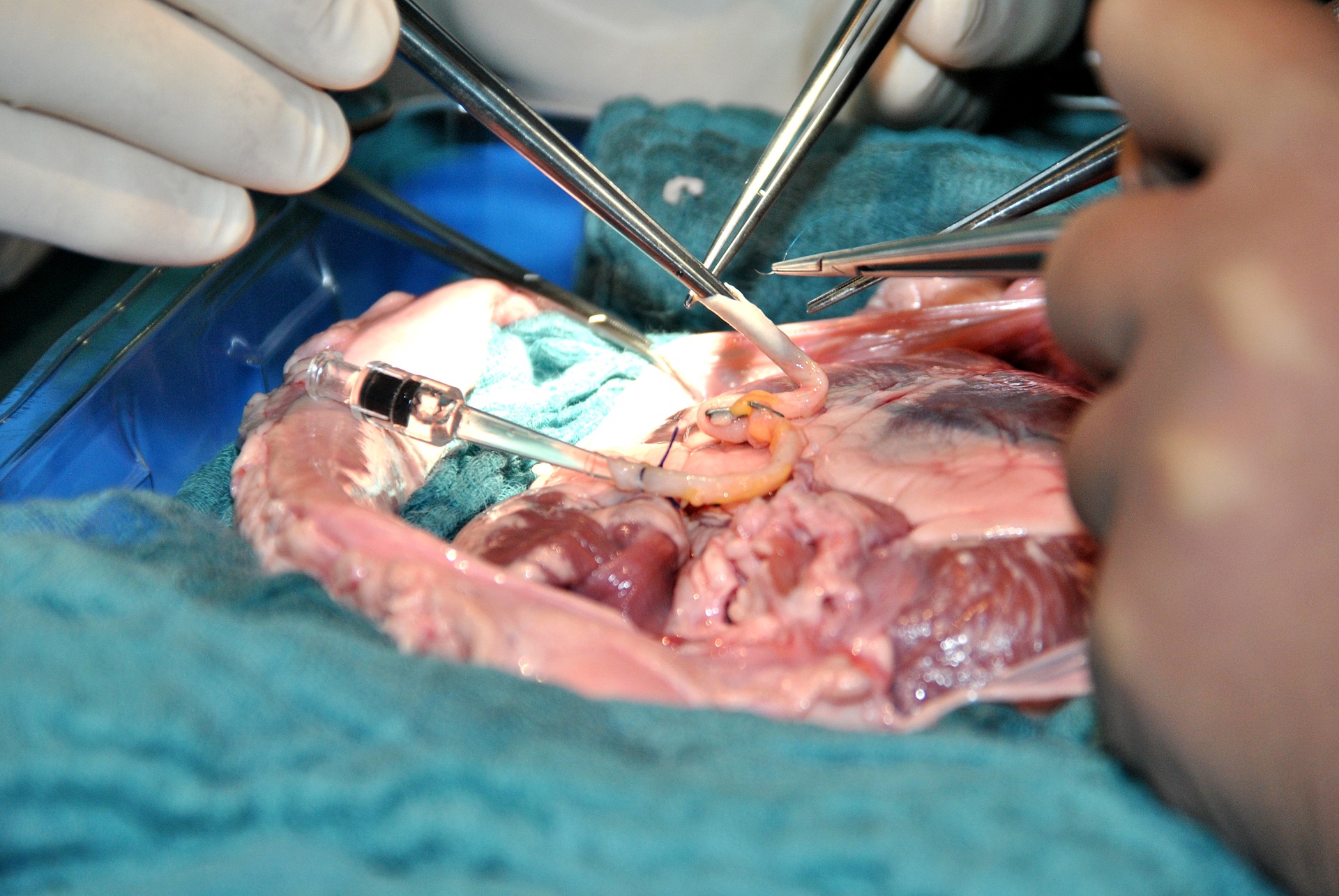 De odlade hjärtceller i labb – har opererats in i människa